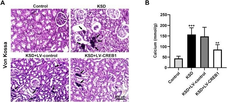 Upregulation of CREB1 significantly reduces kidney crystal deposition in KSD rats, as shown by Von Kossa staining and decreased renal calcium levels.