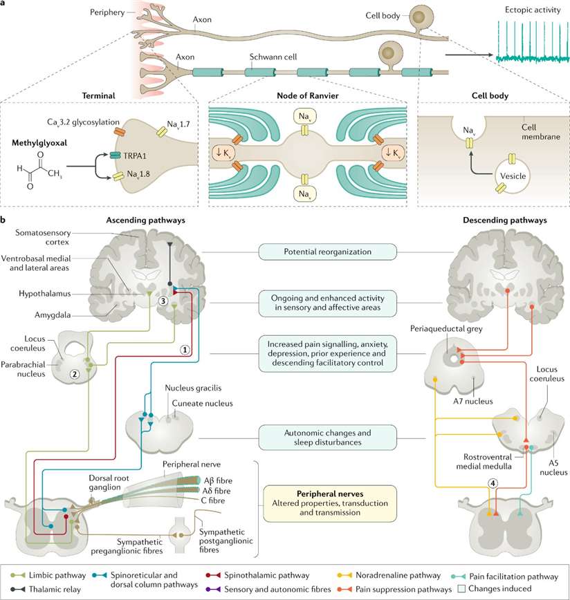Diagram illustrating the various mechanisms within the central and peripheral nervous systems that play a role in the development of neuropathic pain associated with diabetic neuropathy.