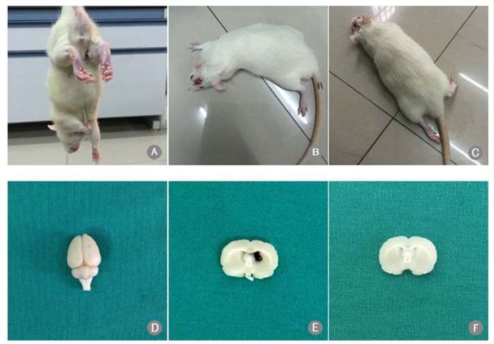 Rat models of intracerebral hemorrhage (ICH) showing Zea Longa scores and hematoma formation: (A–C) Rats with scores 1, 2, and 3; (D) brain after autologous blood infusion; (E) ICH-induced hematoma; (F) sham operation without hematoma.