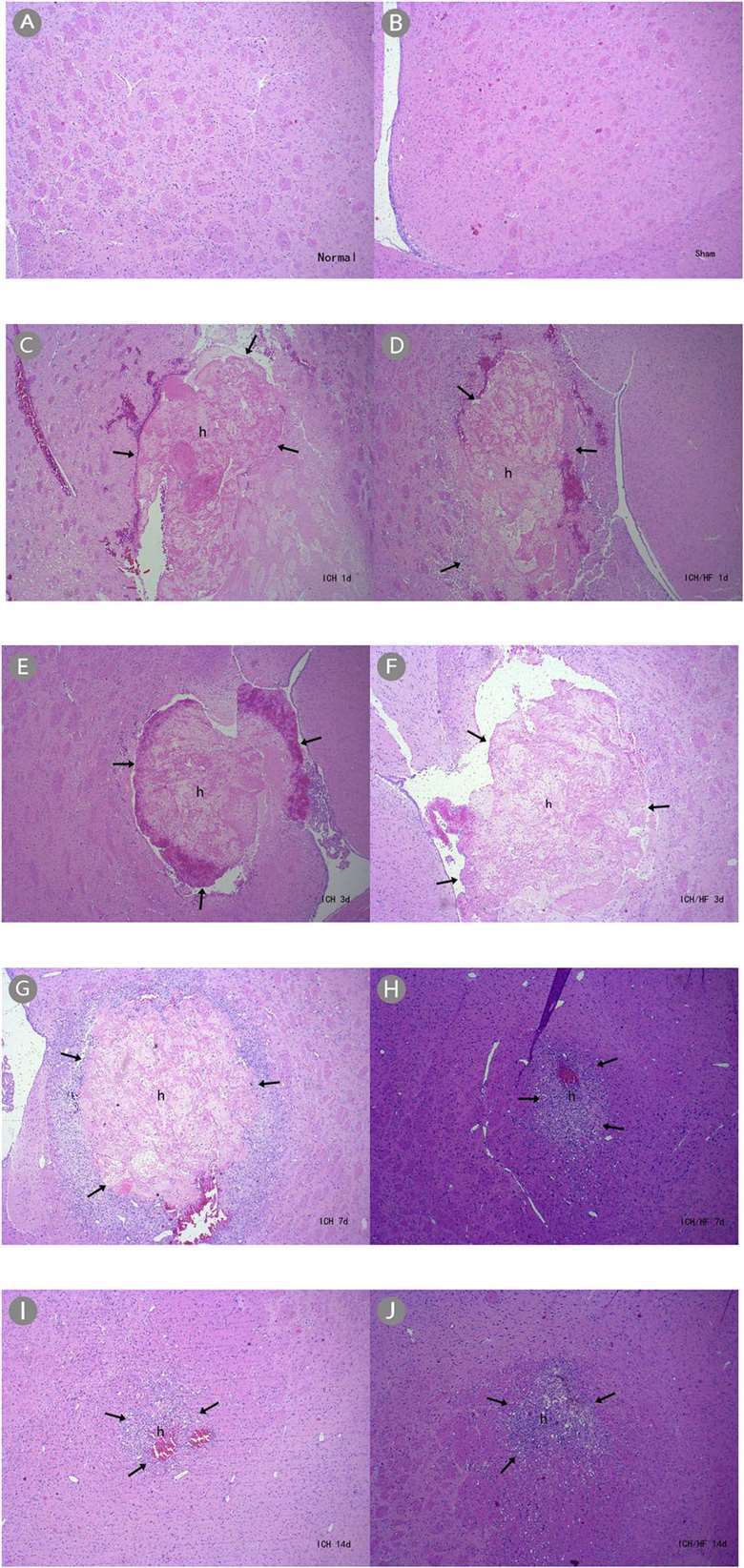 H and E stained images of brain tissue at 40x magnification showing hematoma formation in intracerebral hemorrhage (ICH) models: (A) Normal, (B) sham operation with normal tissue, (C–J) ICH and ICH/HF groups with visible hematomas.