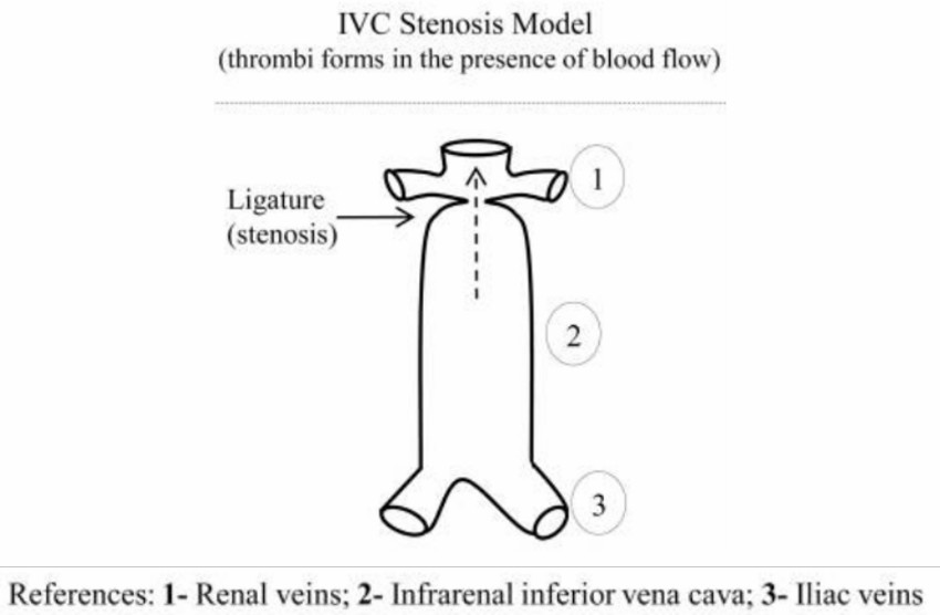 Schematic illustration of the stenosis model for the inferior vena cava (IVC), depicting the narrowing of the vessel and its potential impact.