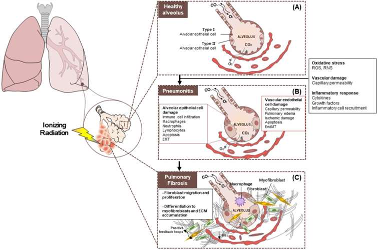 Schematic diagram depicting the pathobiology of radiation pneumonitis and radiation-induced lung injury.