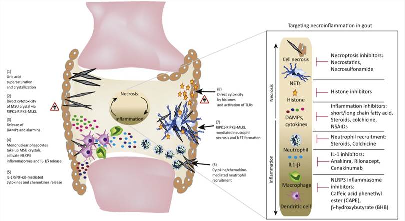 Necroinflammation in acute gouty arthritis