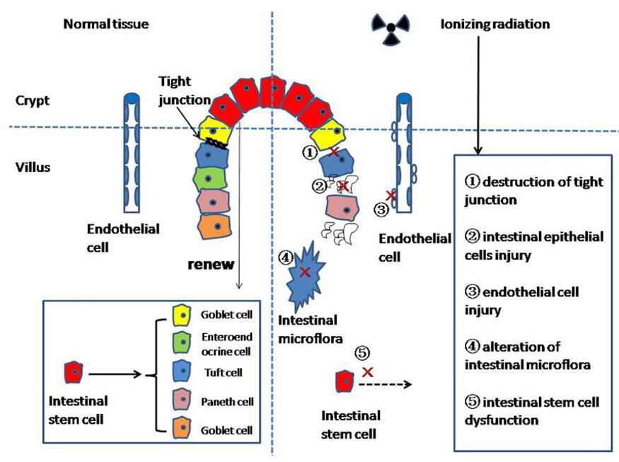 Illustration of the mechanism of radiation enteritis.