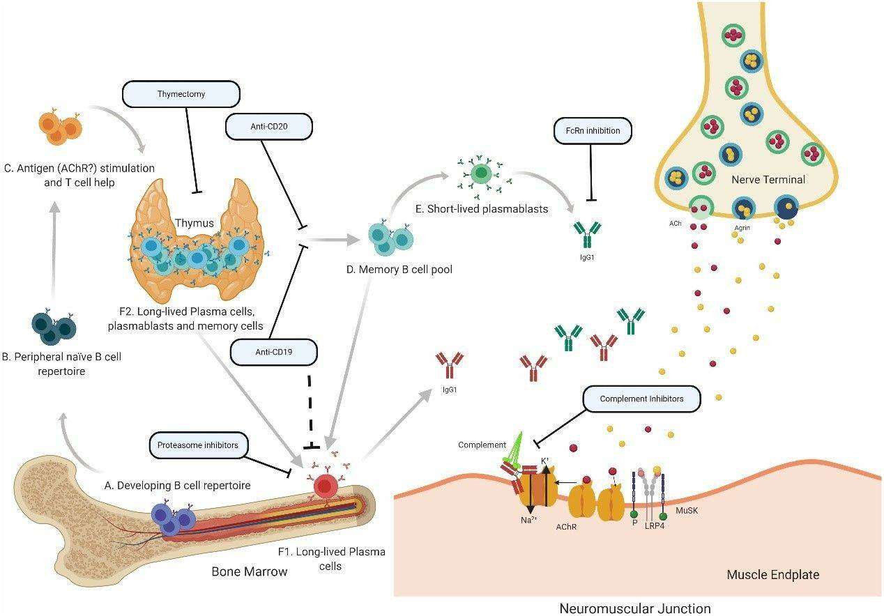 Speculative mechanisms of AChR MG immunopathology, illustrating potential pathways of immune-mediated damage in MG.