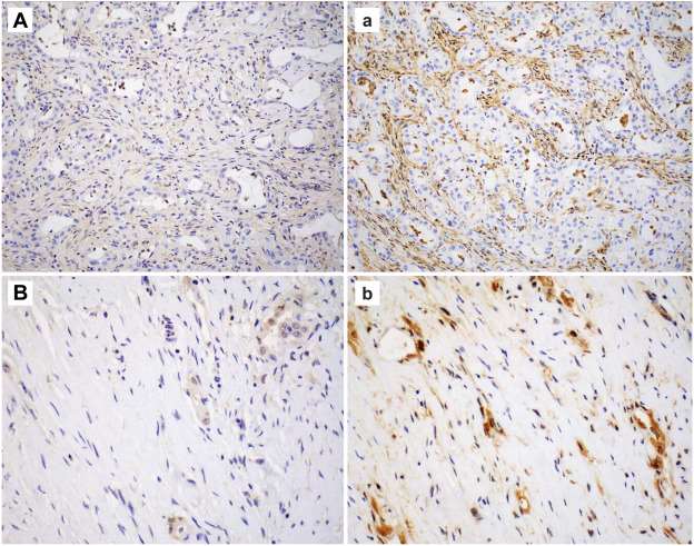 (A, a) Equivocal case with mAb EPR6893 due to poor internal control, interpreted as MTAP loss with mAb 1813. (B,b) Example of poor internal control and heterogenous staining with mAb EPR6893 in a case of epithelioid mesothelioma with desmoplastic stroma, interpreted as retained MTAP expression with mAb 1813.