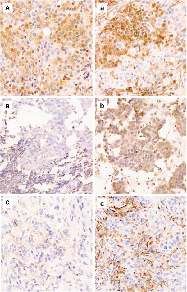 (A, a) case of epithelioid mesothelioma with subclonal loss of MTAP presenting with heterogenous staining difficult to interpret with mAb EPR6893 due to weak “blush” cytoplasmic staining. Tumor cells with subclonal MTAP loss with mAb 1813 are easily identified. (B,b) Example of false positive for MTAP loss with mAb EPR6893, showing retained expression with mAb 1813. (C,c) Example of poor internal control and heterogenous staining with mAb EPR6893 in a case of epithelioid mesothelioma with desmoplastic stroma, interpreted as the loss of MTAP expression with mAb 1813. (C,c) Microphotographs showed at high magnification.