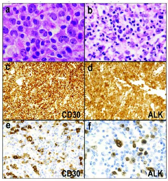 Typical ALK+ALCL histologic morphology, and immunohistochemical maps for CD30 and ALK