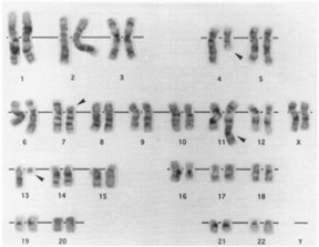 A representative karyotype of SEM cell line after GTG banding showing t (4;11) in combination with a deletion of the short arm of chromosome 7 del(7)(p15) and a deletion of the long arm of chromosome 13 del(13)(q12).