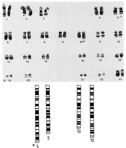 The figure shows a typical chromosome spread obtained for GP2d which possesses a female kat-yotype of 46 chromosomes (a). The abnormalities are represented diagrammatically in (b).