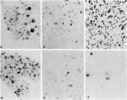 1E9 shows an intracytoplasmic granular staining pattern in monocytes. It also reacts with granulocytes (arrow, A). In frozen sections, 1E9 stains the nuclear membrane of histiocytes (arrow, B) and (C) of interdigitating reticulum cells. Note the difference in staining patterns of monocytes with 2H9 (D) and 1E9 (A). The histiocytes in germinal centers (GC) (arrow, E) are stained by 2H9.