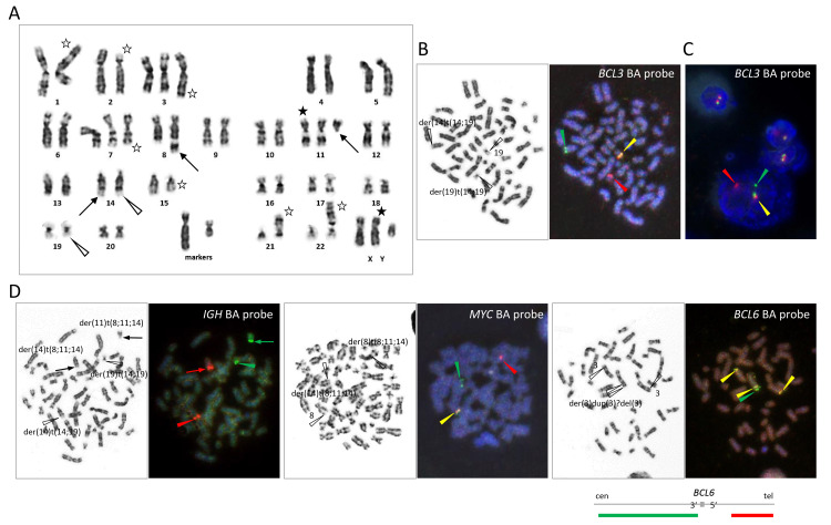 (A) G-banding karyotype. t(14;19)(q32;q13) and t(2;14)(p13;q32) are indicated by open arrowheads and arrows, respectively. (B) Metaphase FISH using the BCL3 BA probe. (C) Interphase FISH using the BCL3 BA probe. (D) Metaphase FISH using the IGH BA probe (left), BCL3 BA probe (middle), and MYC BA probe (right).