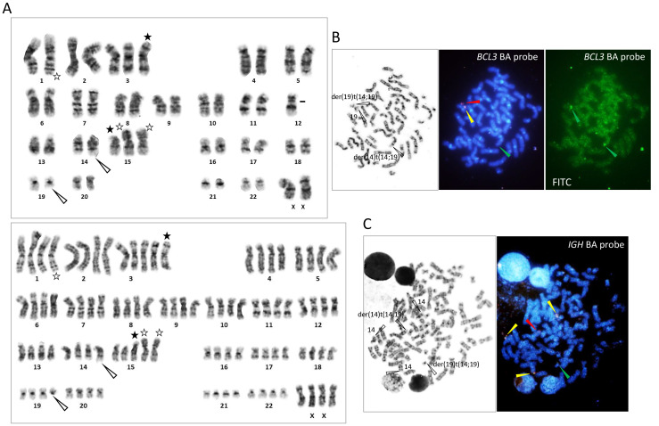 (A) G-banding of diploid-range (top) and tetraploid-range (bottom) karyotypes. (B) Metaphase FISH using the BCL3 BA probe. (C) FISH of a tetraploid-range karyotype using the IGH BA probe.