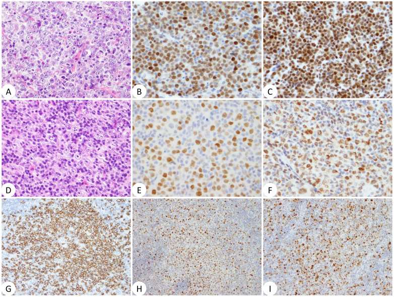 (A), hematoxylin & eosin (H&E) staining (original magnification, 40× objective lens); (B), anti-MYC immunostaining (40×); (C), anti-BCL3 (40); (D), H&E (40×); (E), anti-MYC (40×); (F), anti-BCL3 (40×); (G), anti-CD20 (20×); (H), anti-BCL6 (20×); and (I), anti-MUM1 (20×).