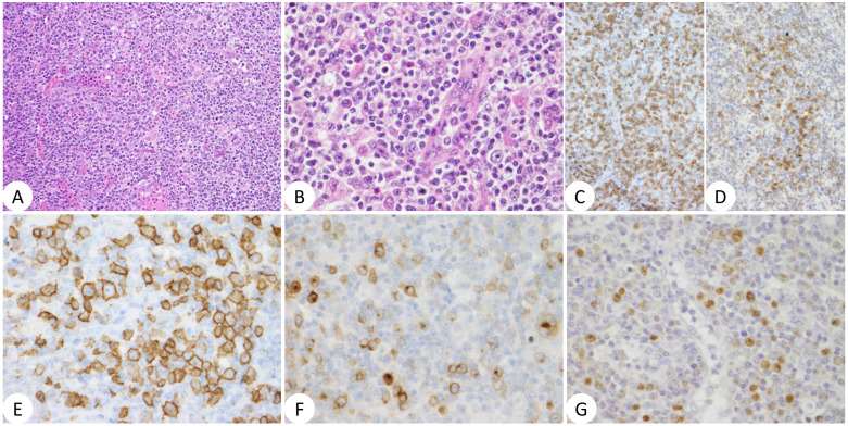 (A), H&E (20×); (B), H&E (40×); (C), anti-CD3 (20×); (D), anti-PD-1 (20×); (E), anti-CD20 (40×); (F), anti-CD30 (40×); and (G), EBER ISH (40×).