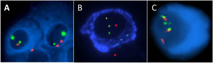 A. CD138 antigen (blue) and FISH probes targeting 17p (red) and chromosome 17 centromere (green). B. Cytoplasmic immunoglobulin (blue) showing a positive plasma cell with a balanced IGH::CCND1 translocation demonstrated by two fusion signals, one IGH (red) and one CCND1 (green). C. CD138-positive plasma cell with IGH::FGFR3 translocation with two fused signals, one IGH (red) and one FGFR3 (green) signal pattern.