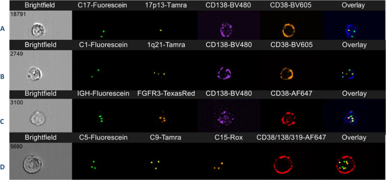 A. del(17p) showing two (diploid) signals for the chromosome 17 centromere and one signal for the TP53 locus at 17p13 in a CD138/CD38-positive plasma cell. B. 1q21 gain showing two (diploid) signals for the chromosome 1 centromere and three signals for the CKS1B locus at 1q21 in a CD138/CD38-positive plasma cell. C. CD38/CD138-positive plasma cell showing a balanced IGH::FGFR3 translocation. There are two fusion signals corresponding to the derivative chromosomes 4 and 14 and one signal for each of FGFR3 (4p16) and IGH (14q32). D. Multi-probing FISH panel showing trisomy of chromosomes 5, 9, and 15 in a CD138/CD38/CD319-positive plasma cell indicating hyperdiploidy.