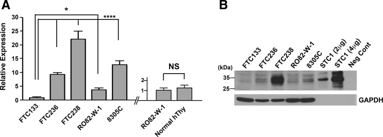 Analysis of STC1 expression in thyroid cancers.