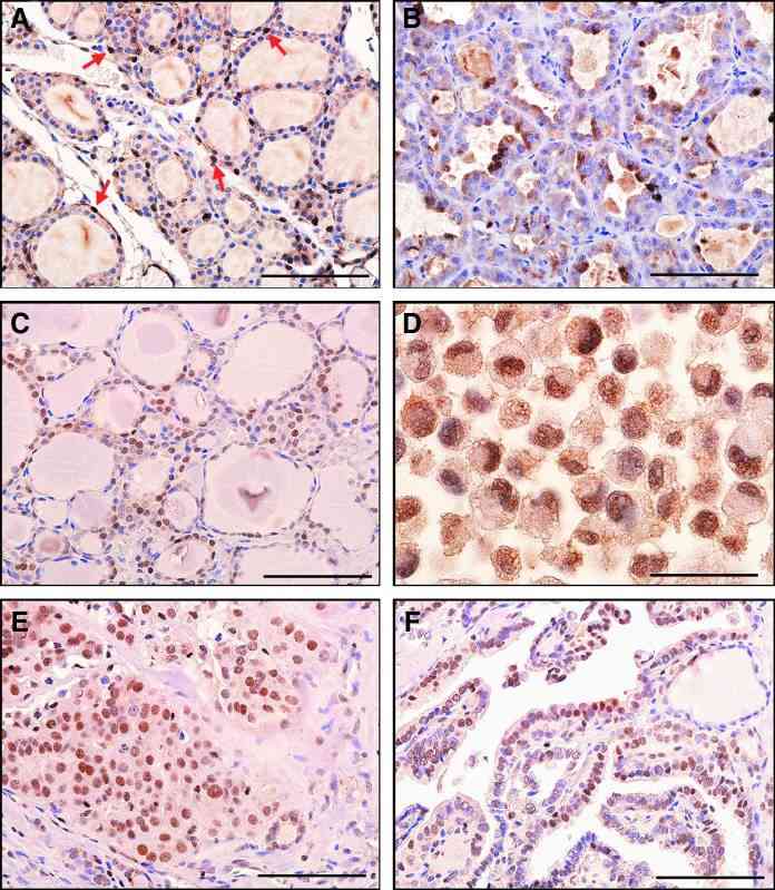 STC1 antigen/protein expression in thyroid tissues.