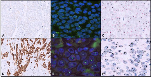 The HER2/neu immunohistochemistry (IHC) score is 1+ (A), fluorescence in situ hybridization (B) and dual-color dual in situ hybridization (C). The HER2/neu IHC score is 3+ (D), confirmed by both FISH (E) and D-DISH (F).