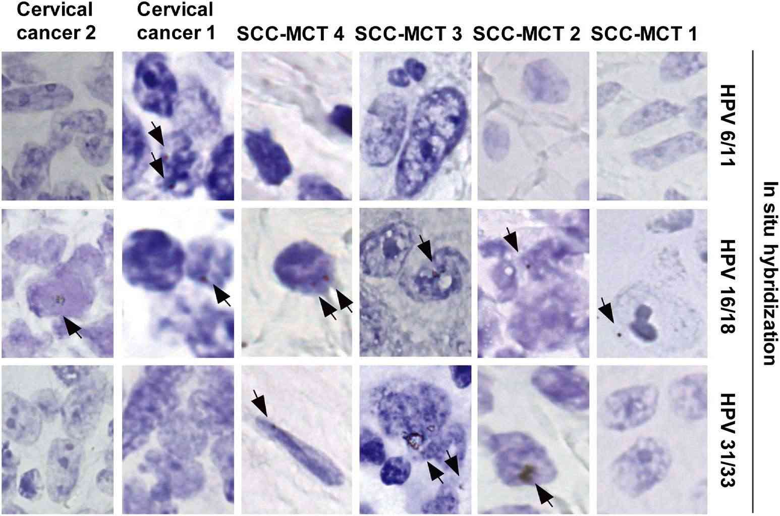 Detection of Human papillomavirus (HPV) by in situ hybridization (biotin-labeled DNA probes).