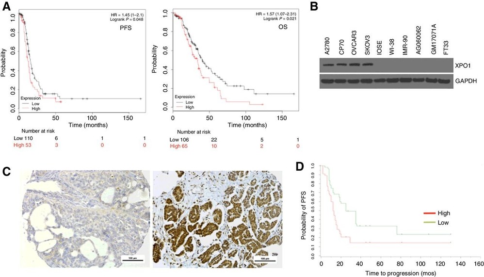 XPO1 is overexpressed in human ovarian cancer and its expression is linked to poorer survival outcomes.