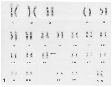 Representative G-banded karyotype of the PF-382 cells showing 46X, Xq-,15p+.