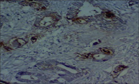 Moderately differentiated adenocarcinoma of stomach stained slightly for HER2 in IHC analysis (high power).