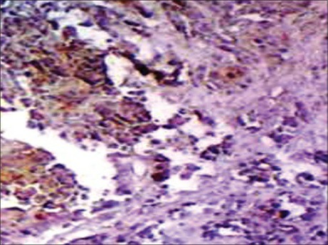 Poorly differentiated adenocarcinoma of stomach stained strongly for HER2 NEU IHC staining (Low power).