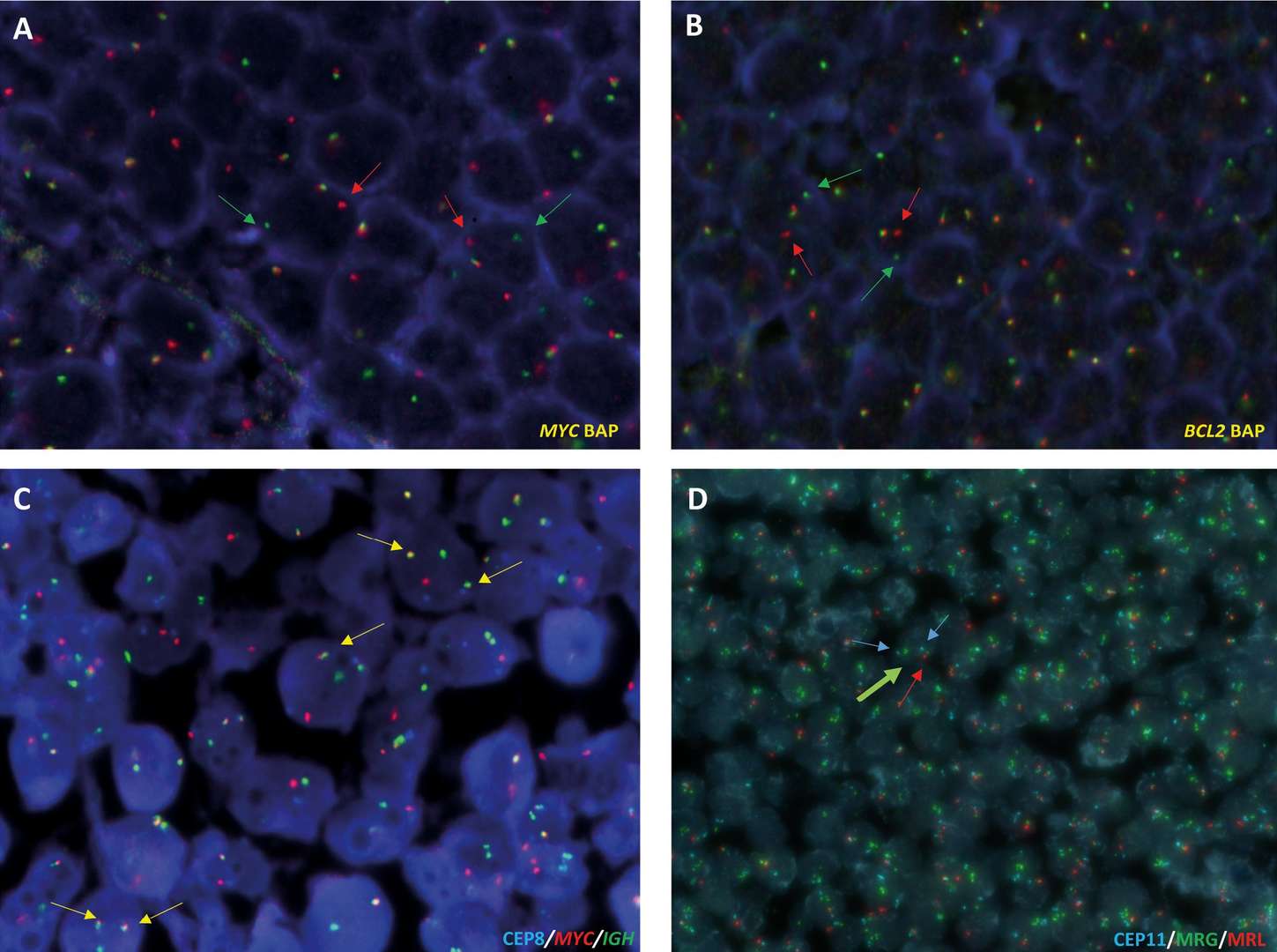 FISH analysis of 14q32 (IGH)-related translocations and 11q abnormalities in B-cell lymphomas using formalin-fixed paraffin-embedded (FFPE) tissue samples.