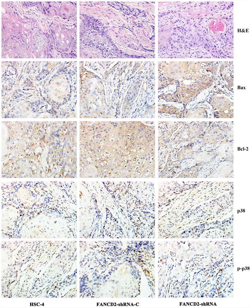 Conventional histopathological H&E staining showed that the three groups of tumors demonstrated the characteristics of squamous cell carcinoma. Positive expression of Bax and Bcl2 was found in the cytoplasm, and positive expression of p38 was primarily found in the cytoplasm but also partly in the nucleus. Positive expression of p-p38 was observed only in the nucleus.