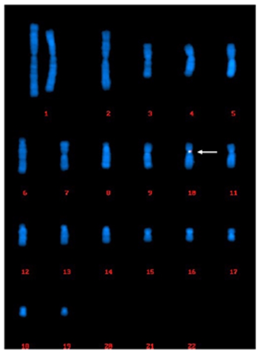 Example of FISH-based clonality analysis for MCB: centromeric region of chr.10.