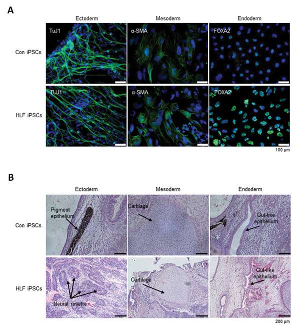 Differentiation of cHCC-CC-derived human liver fibroblasts iPSCs.