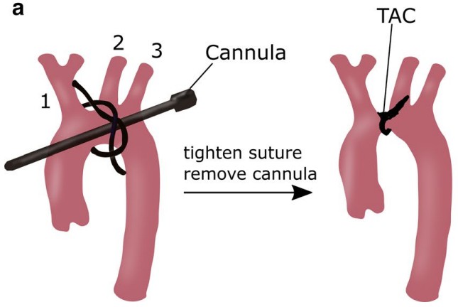 Schematic diagram of Transverse Aortic Constriction (TAC).